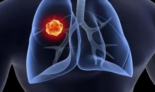 肺癌晚期能活多久